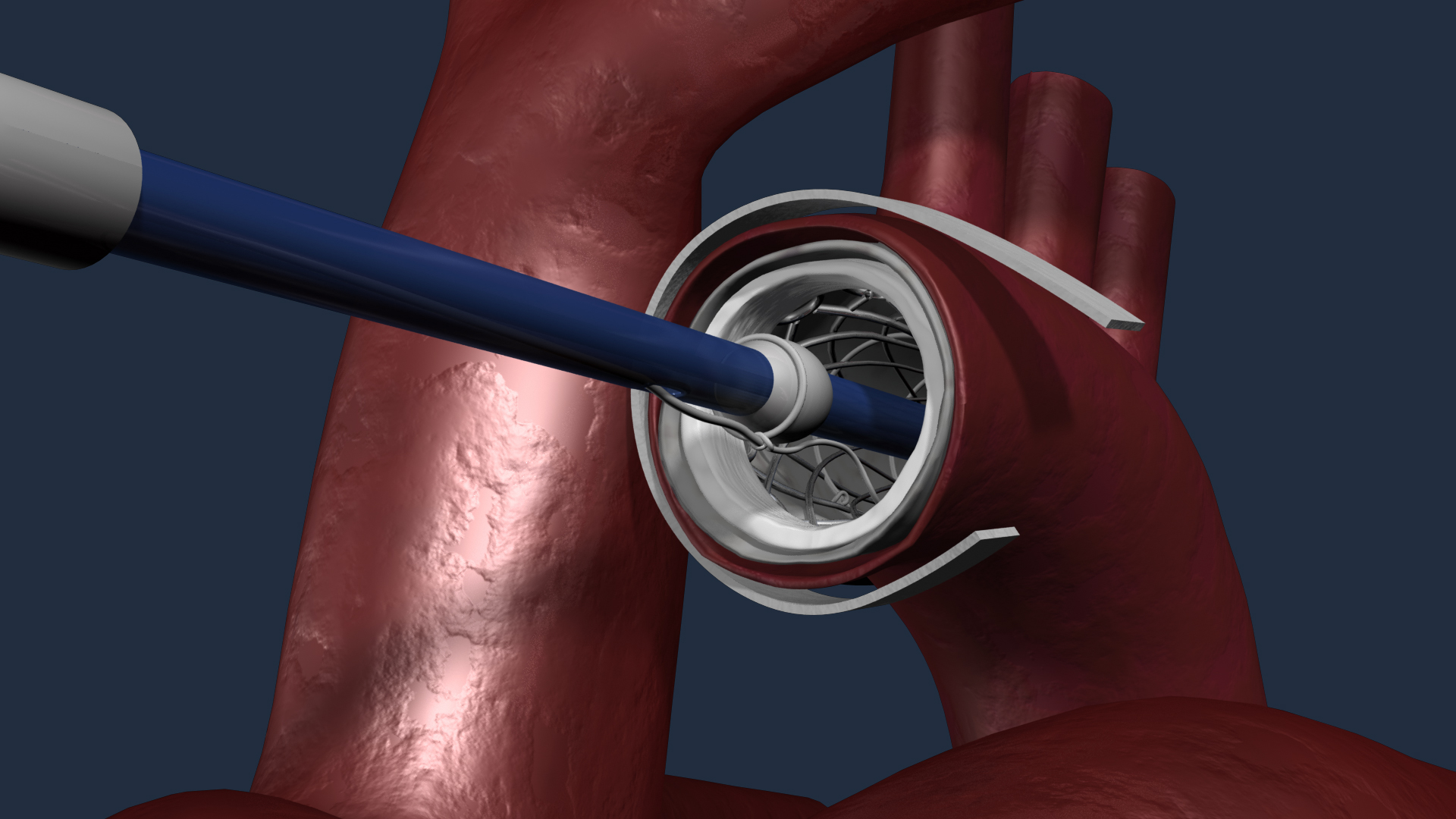 Dissection Stent – Medical animation