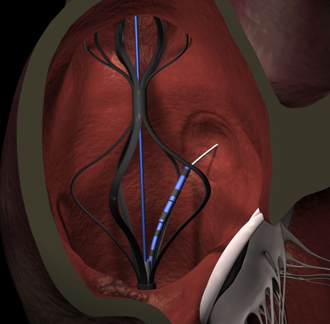 Transseptal Puncture Process KAPSUS – Medical animation